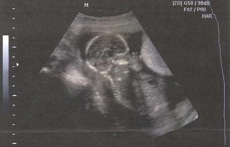 Узи № 3 (он же 2-й скрининг)