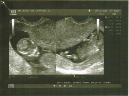 Ктр 11 недель. КТР эмбриона в 12 недель. КТР В 12 недель УЗИ. КТР 12.5 мм. КТР на 11-12 неделе.